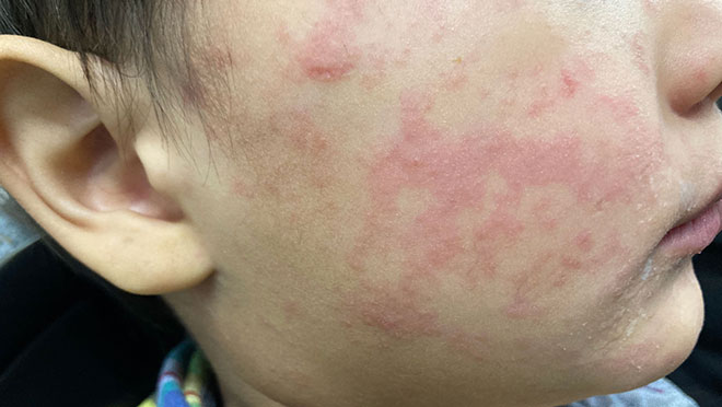 081326-measles-CDC.jpg